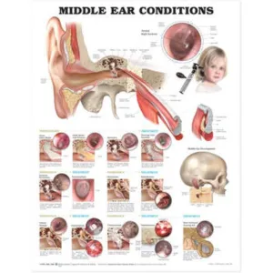 Chart of Middle Ear Conditions